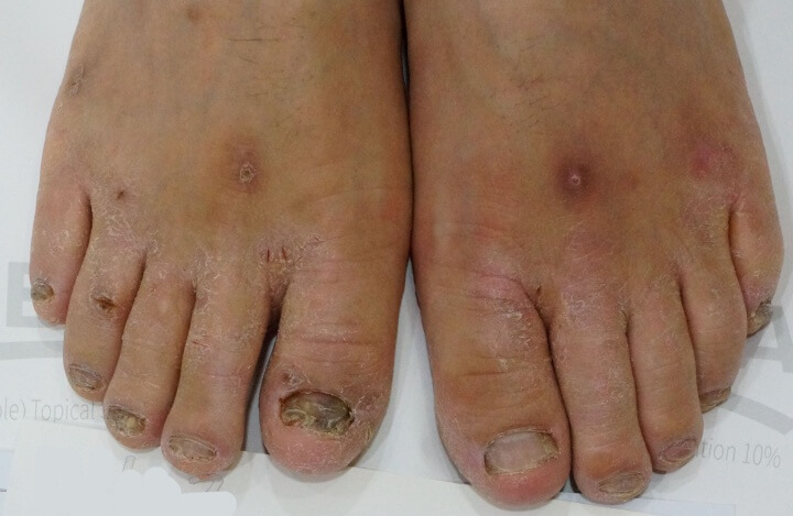 오니코레이저 발톱 무좀 후기