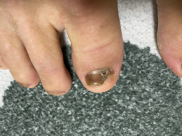 오니코레이저 발톱 무좀 후기