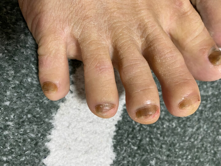 오니코레이저 발톱 무좀 후기