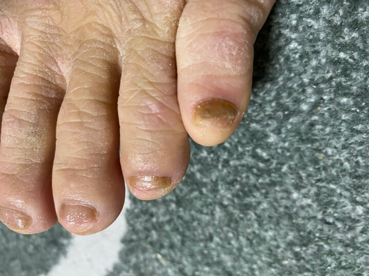 오니코레이저 발톱 무좀 후기