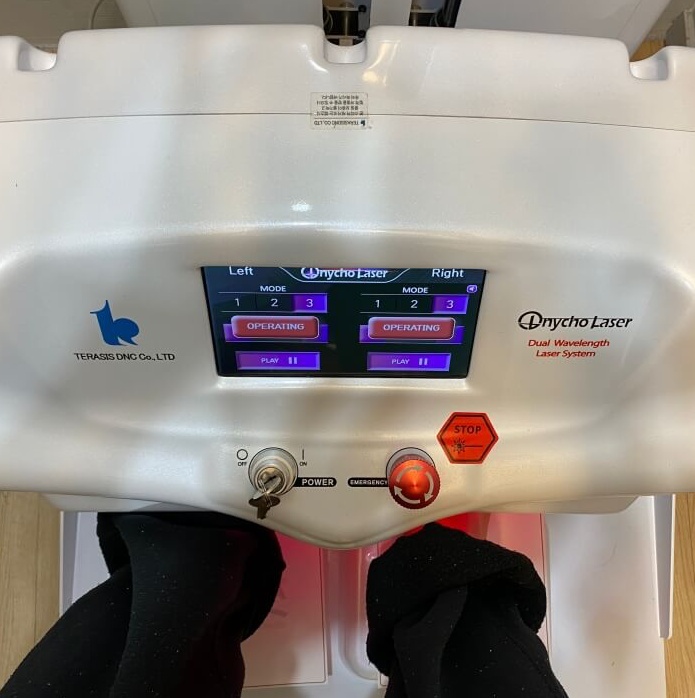 오니코레이저 발톱 무좀 후기